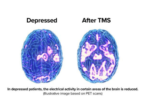 Depression | TMS Institute of Arizona